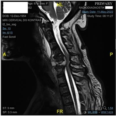 Improving functional outcomes and quality of life in an elderly woman with sarcopenia and spinal Tuberculosis: A case report